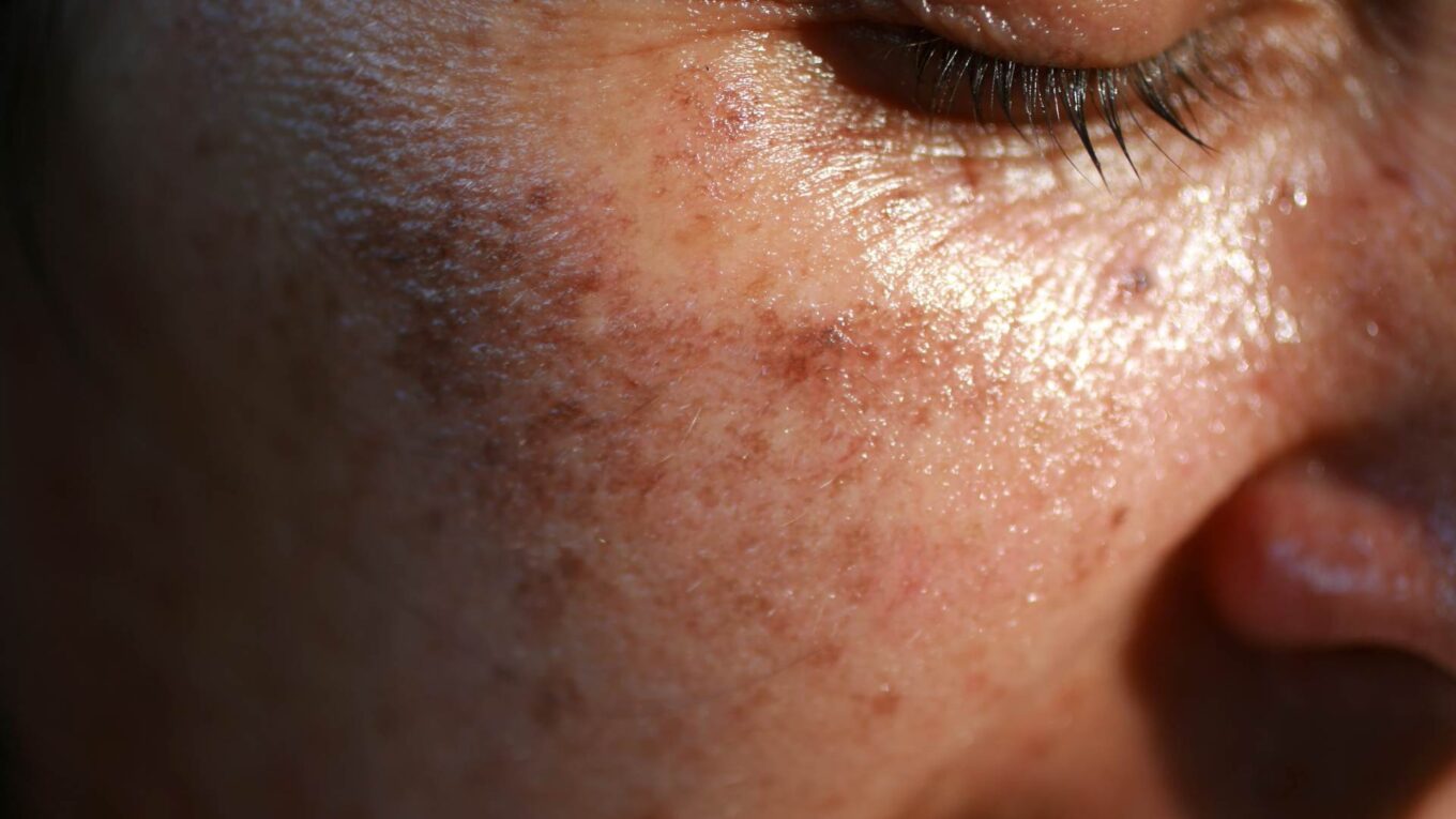 rougeurs du visage