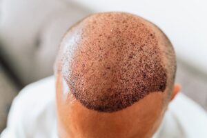 greffe de cheveux