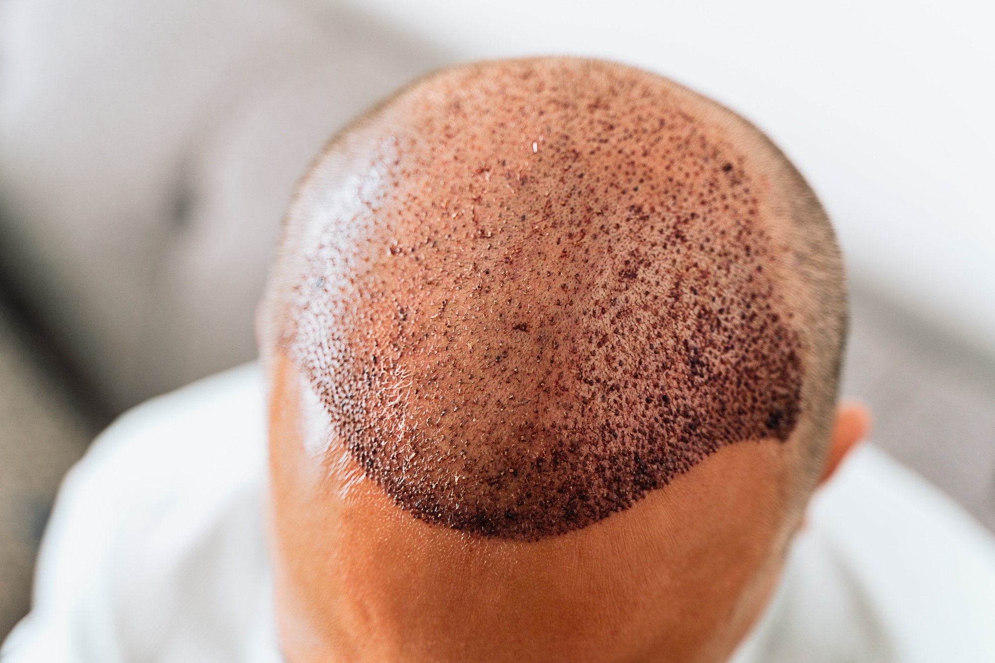 greffe de cheveux
